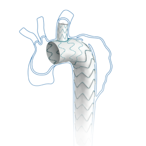 Endoprótesis Castor